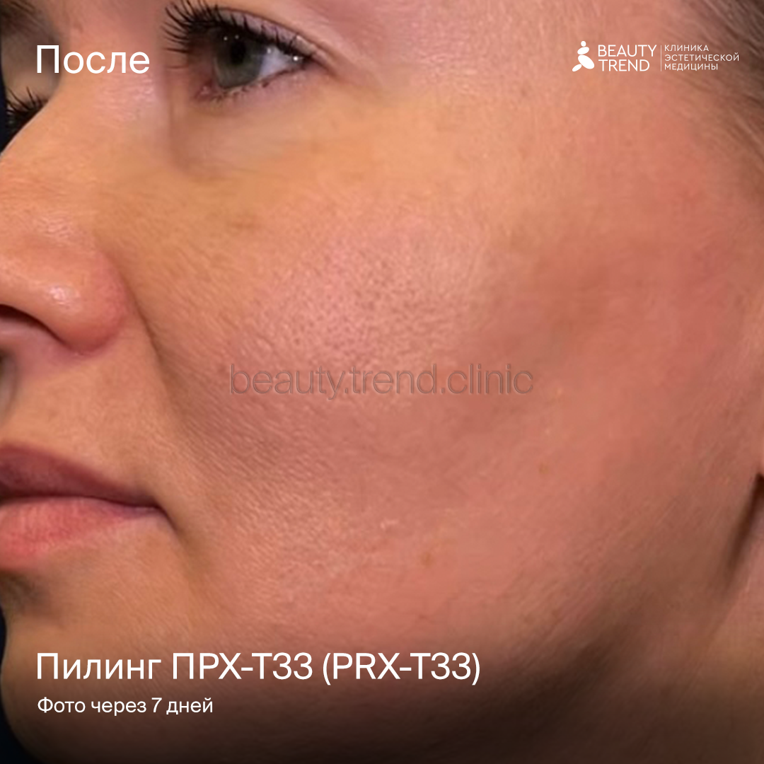 Пилинг PRX - после 1